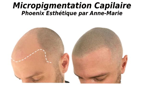 Traitement cellulite à Montréal chez Phoenix Esthétique par Anne-Marie