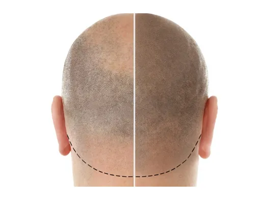 Économisez sur la micropigmentation capillaire avec nos rabais